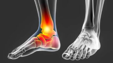 What Is Triple Arthrodesis Of The Foot And How Can It Benefit You